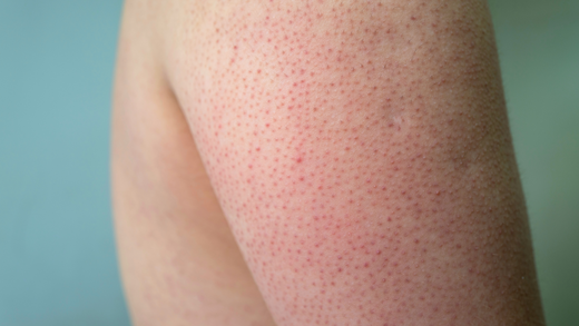 How the African Net Sponge Can Help with Keratosis Pilaris (KP)